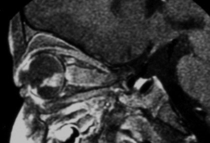 视网膜母细胞瘤(图4)